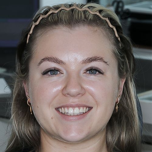 Composite veneers - before - Shannen - 3dental